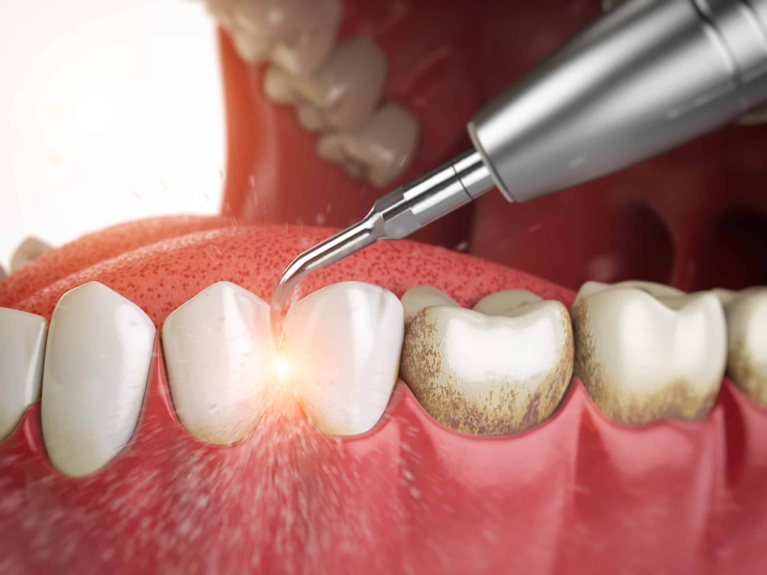 Professional,Teeth,Cleaning.,Ultrasonic,Teeth,Cleaning,Machine,Delete,Dental,Calculus