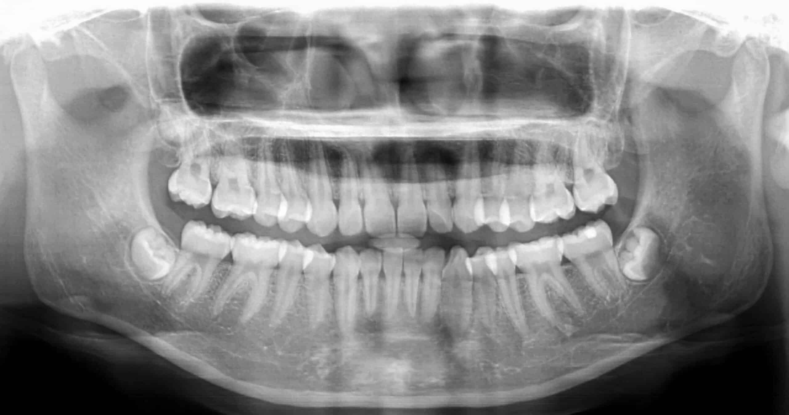 Panoramic,Dental,Xray,Shows,Fixed,Teeth,Amalgam,Seal.x-ray,For,Dental