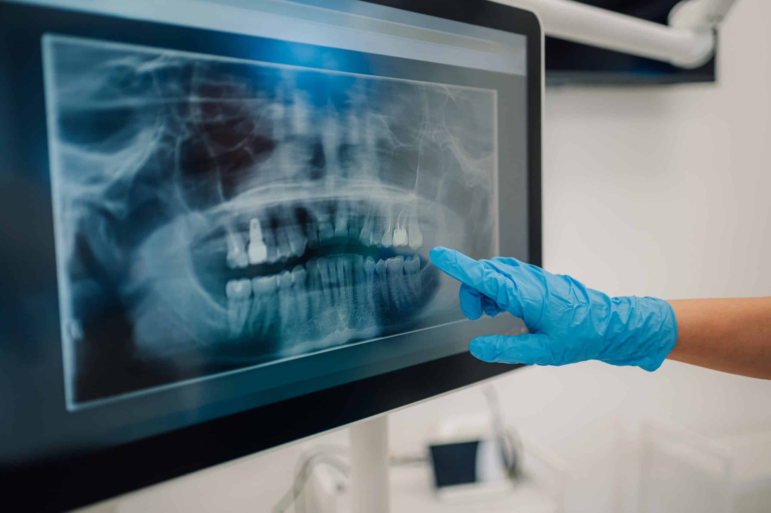 Dentist,Wearing,Blue,Medical,Gloves,Pointing,At,A,Dental,X
